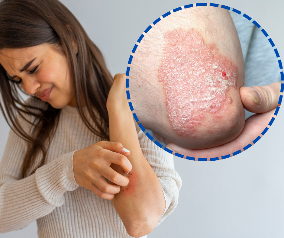 Dr Kiseki: A Natural Solution for Eczema, Psoriasis & Skin Health